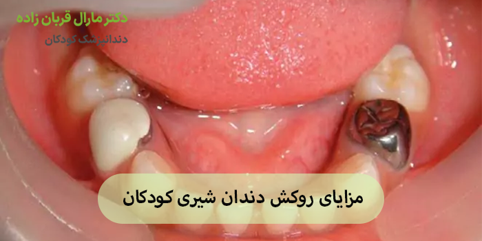 مزایای روکش دندان شیری کودکان