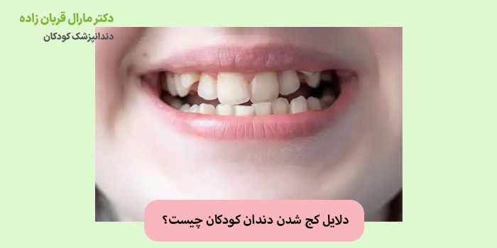 دلایل کج شدن دندان کودکان چیست؟