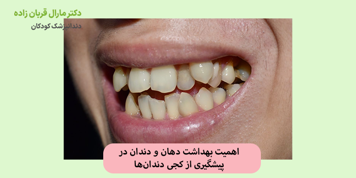اهمیت بهداشت دهان و دندان در پیشگیری از کجی دندانها