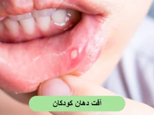 آفت دهان کودکان