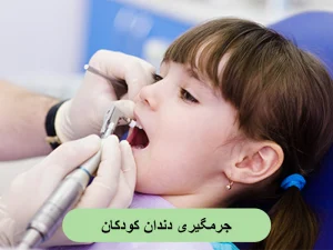 جرمگیری دندان کودکان