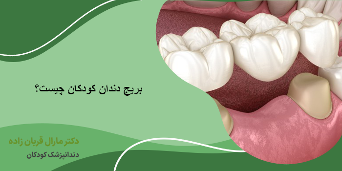 بریج دندان کودکان