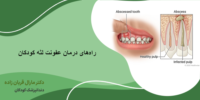 راههای درمان عفونت لثه کودکان