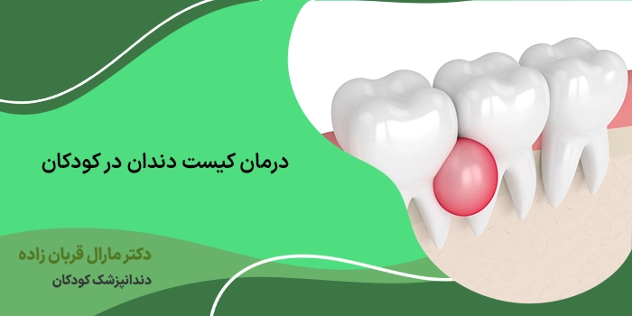درمان کیست دندان در کودکان