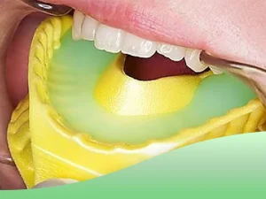 بهترین سن فلوراید تراپی