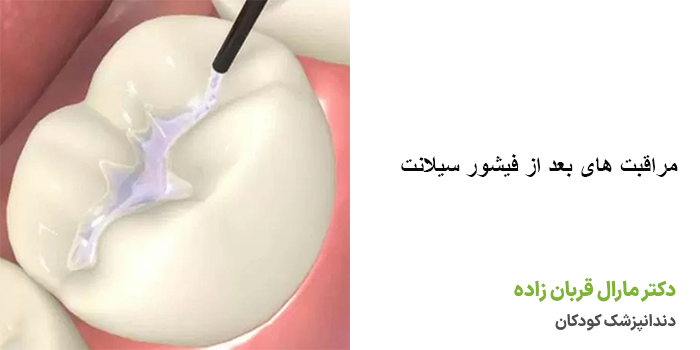 مراقبت های بعد از فیشور سیلانت
