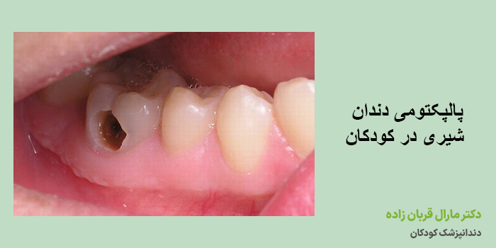 پالپکتومی دندان شیری
