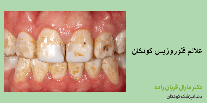 درمان فلوروزیس در کودکان چگونه انجام میشود؟
