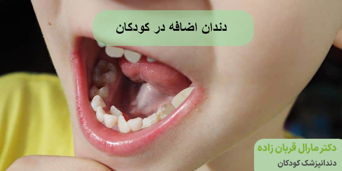 دندان اضافه در کودکان
