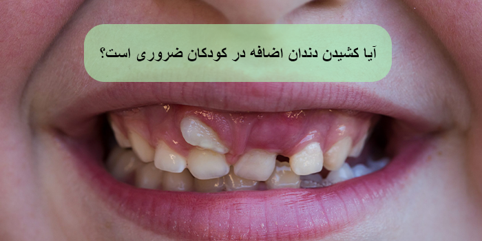آیا کشیدن دندان اضافه در کودکان ضروری است؟