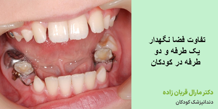 تفاوت فضا نگهدار یک طرفه و دو طرفه در کودکان