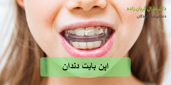 اپن بایت دندان