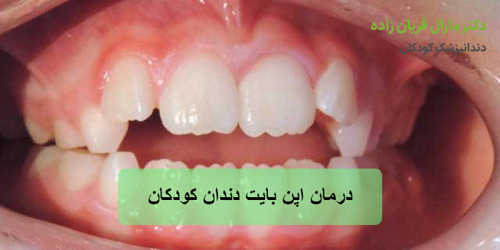 درمان اپن بایت دندان کودکان