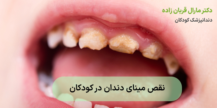 نقص مینای دندان در کودکان