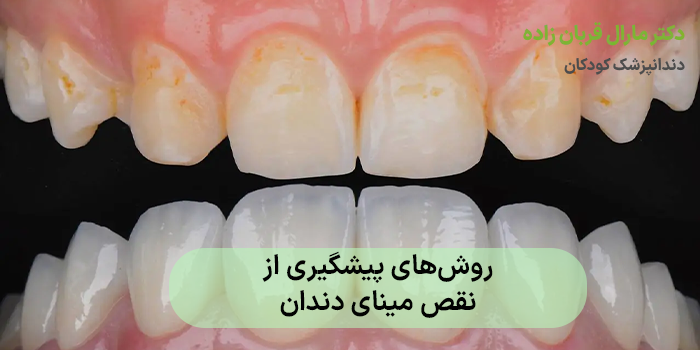 روشهای پیشگیری از نقص مینای دندان