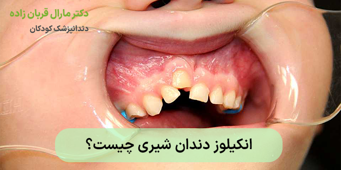 انکیلوز دندان شیری