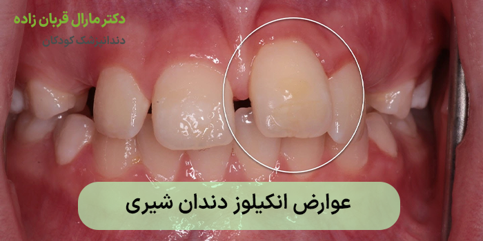 عوارض انکیلوز دندان شیری