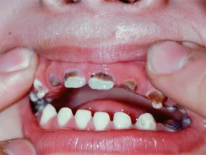 سندرم شیشه شیر