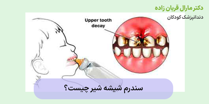 سندرم شیشه شیر