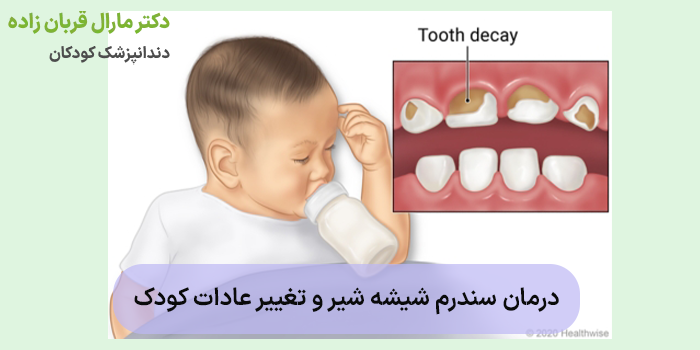 درمان سندرم شیشه شیر و تغییر عادات کودک