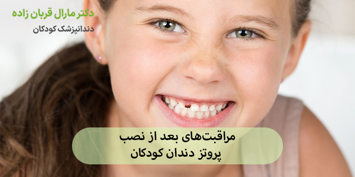 مراقبتهای بعد از نصب پروتز دندان کودکان