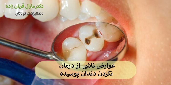 عوارض ناشی از درمان نکردن دندان پوسیده