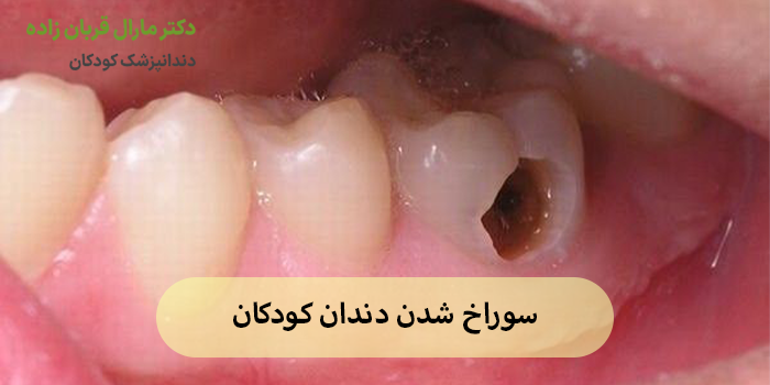 سوراخ شدن دندان کودکان