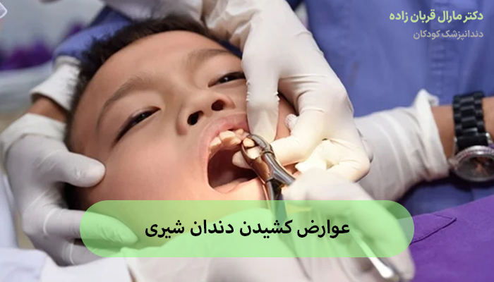 عوارض کشیدن دندان شیری