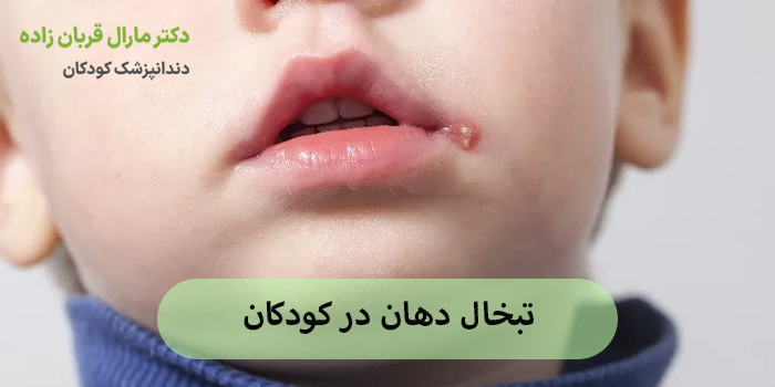 تبخال دهان در کودکان