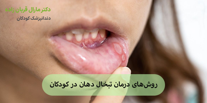 روشهای درمان تبخال دهان در کودکان