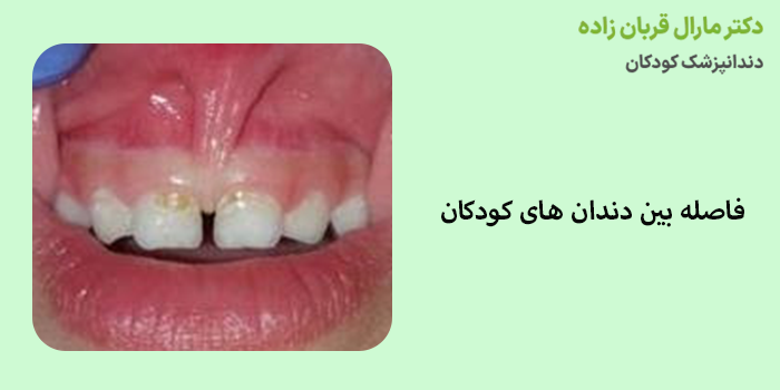 فاصله بین دندان های کودکان
