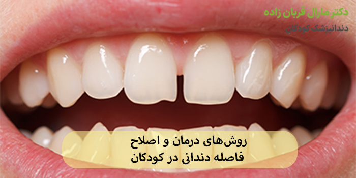 روشهای درمان و اصلاح فاصله دندانی در کودکان