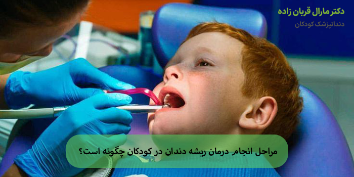 مراحل انجام درمان ریشه دندان در کودکان چگونه است؟