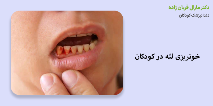 خونریزی لثه در کودکان