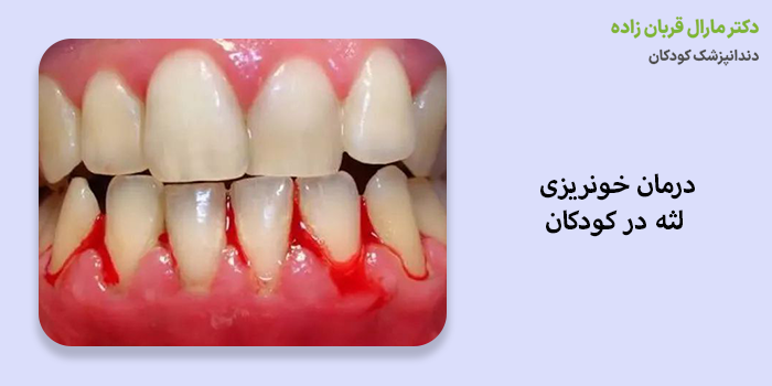 درمان خونریزی لثه در کودکان