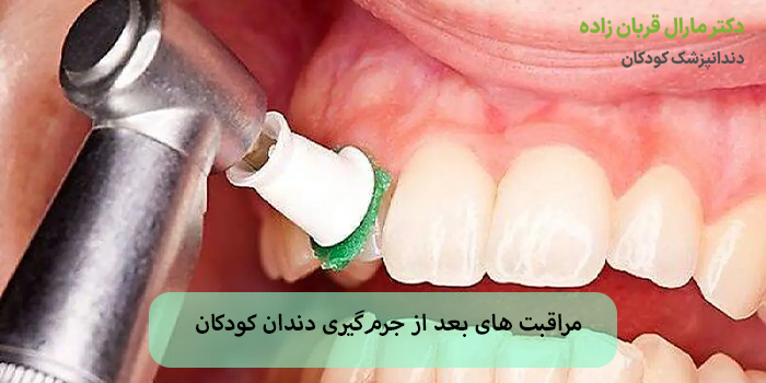 مراقبت های بعد از جرمگیری دندان کودکان
