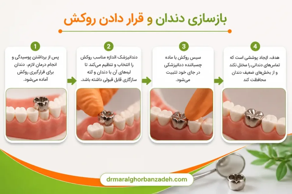 بازسازی دندان و قرار دادن روکش — بررسی تطابق روکش با دندانهای کودک پس از قرارگیری روکش