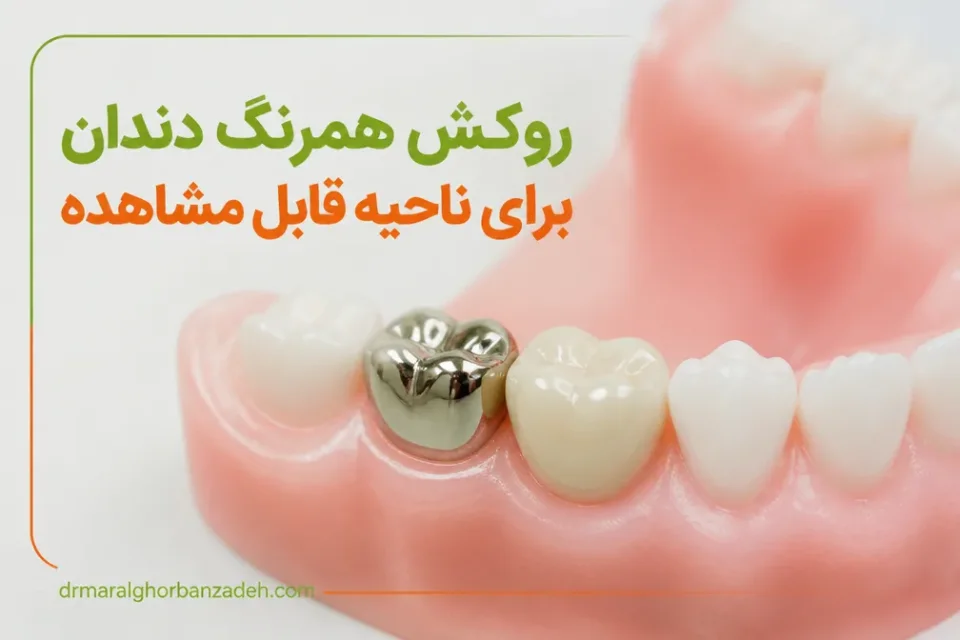 روکش همرنگ دندان برای ناحیه قابل مشاهده — مقایسه روکش استیل و روکش همرنگ روی دندانهای شیری آسیاب کودک
