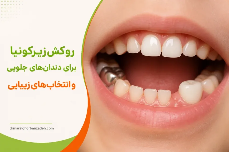 روکش زیرکونیا برای دندانهای جلویی و انتخابهای زیبایی — مقایسه روکش استیل و روکش زیرکونیا در دندانهای شیری کودکان